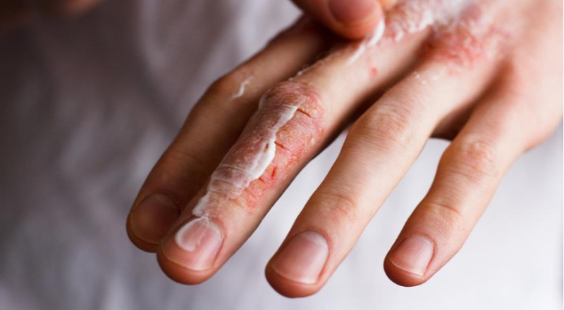 Аллергия на холод на руках и лице зимой, что с ней делать и как лечить