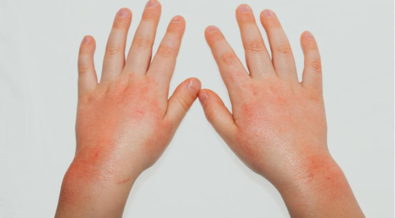 Аллергия на холод на руках и лице зимой, что с ней делать и как лечить